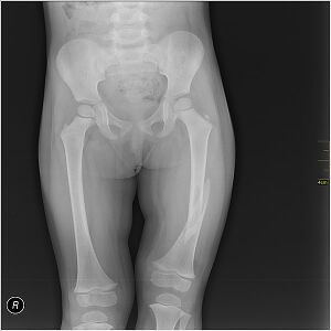 Fracture of the diaphysis of the femur in a child