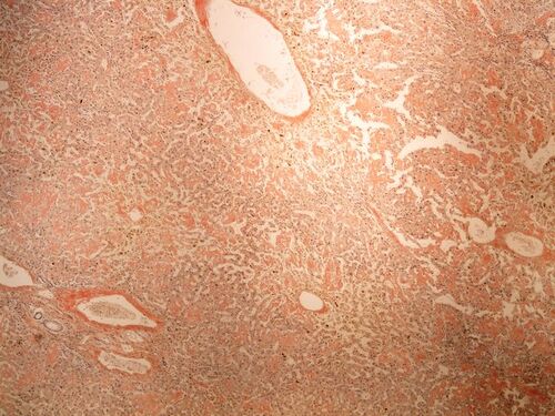 Amyloidosis liver amyloidoza jater kongo 4x.jpg