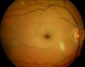 Cherry spot - occlusion of the retinal artery centralis