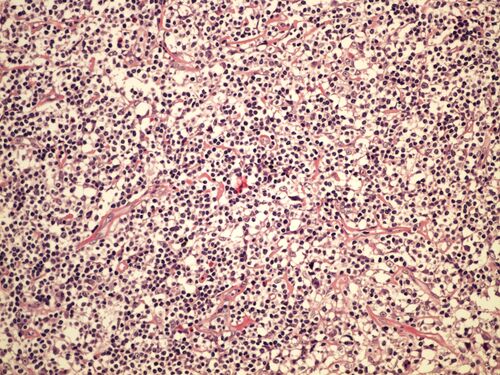 Classic Hodgkin lymphoma nodular sclerosis klasicky Hodgkinuv lymfom nodularni sklerosa 20x.jpg