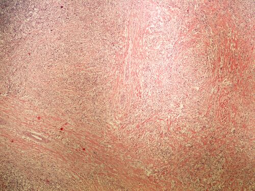 Classic Hodgkin lymphoma nodular sclerosis klasicky Hodgkinuv lymfom nodularni sklerosa 4x.jpg
