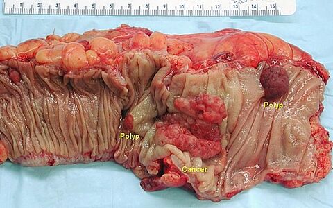 Polyposis colorectal cancer (lesions in the middle, lesions on the right and left are polyps).