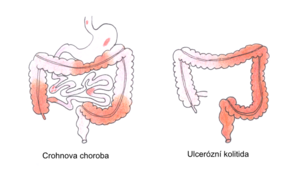 Crohn's disease ulcerative colitis