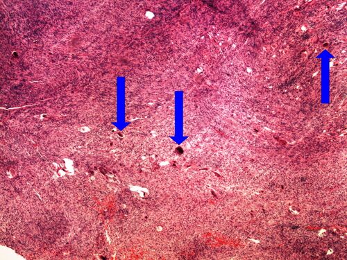 L12-8 meningioma meningeom s psamomaty 4x oznaceno.jpg
