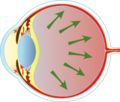 Closed-angle glaucoma