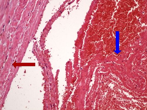 Z5-4 acute thrombosis 20x .jpg
