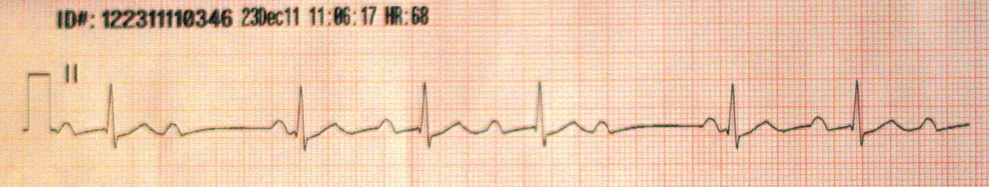 1st type