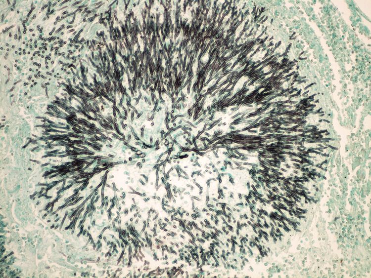 Grocott (mycosis) Grocott (prukaz plisne) 20x.jpg