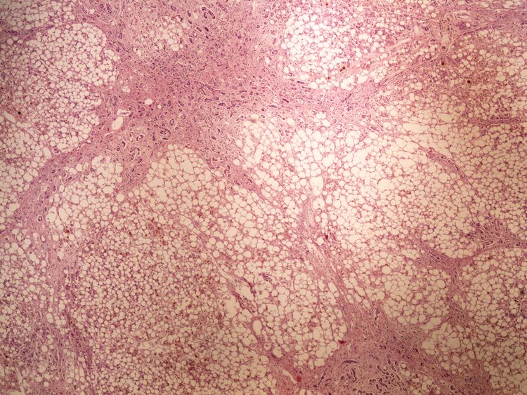 Steatosis hepatis steatosa jater 4x.jpg