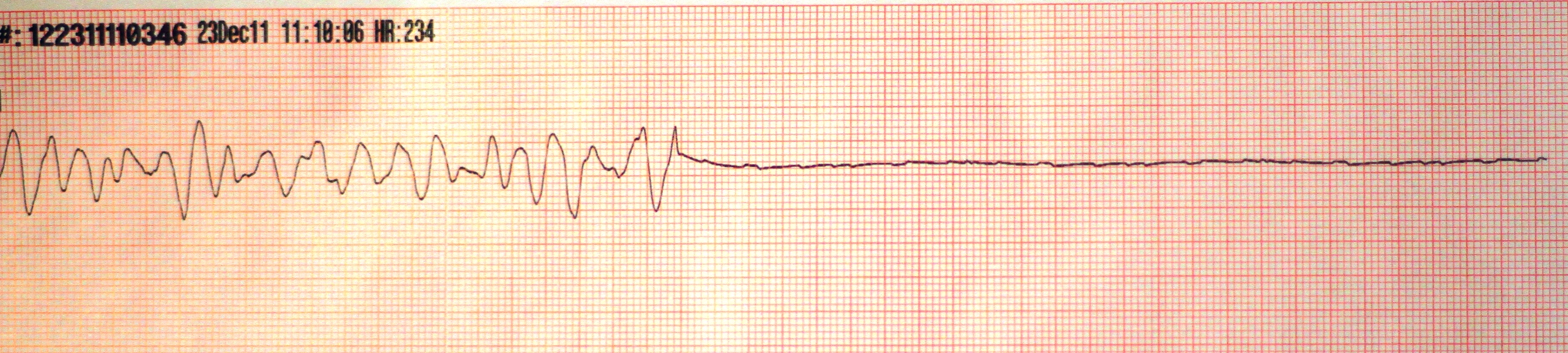 Asystole