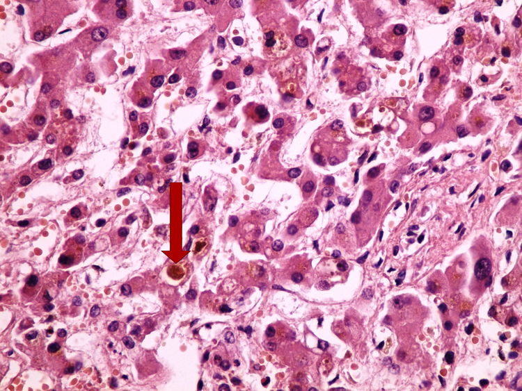 Z4-3 bilirubin 40x oznaceno.jpg
