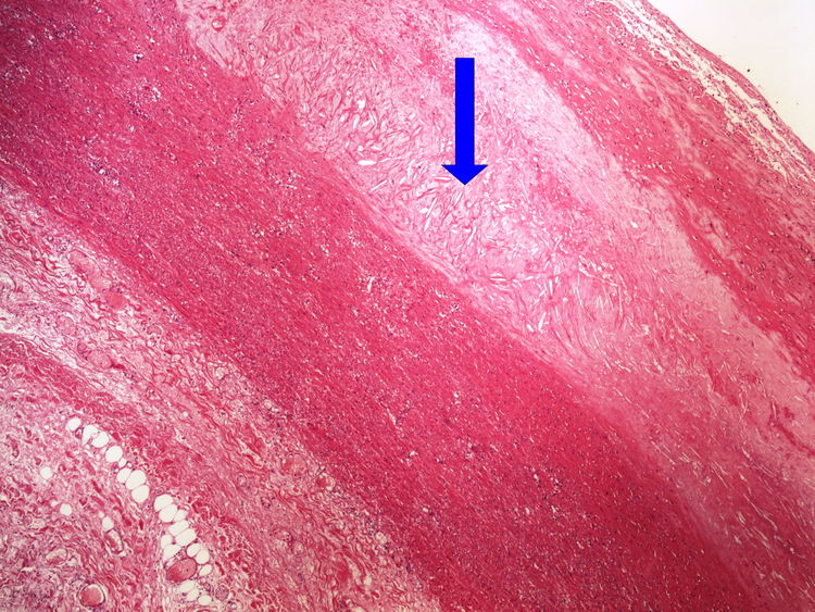 Z4-6 cholesterol clefts cholesterolove krystaly 4x oznaceno.jpg