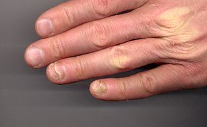 Ochnylosis