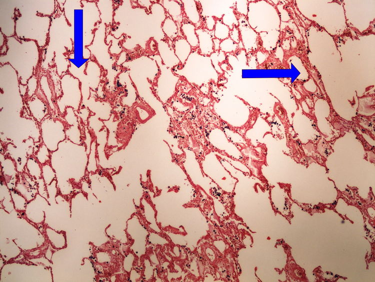 Z1-9 Pearls reaction (lung) prukaz zeleza (plice) 4x oznaceno.jpg