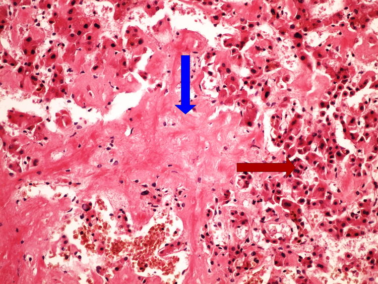 Z3-13 amyloidosis liver amyloidoza jater HE 20x oznaceno.jpg