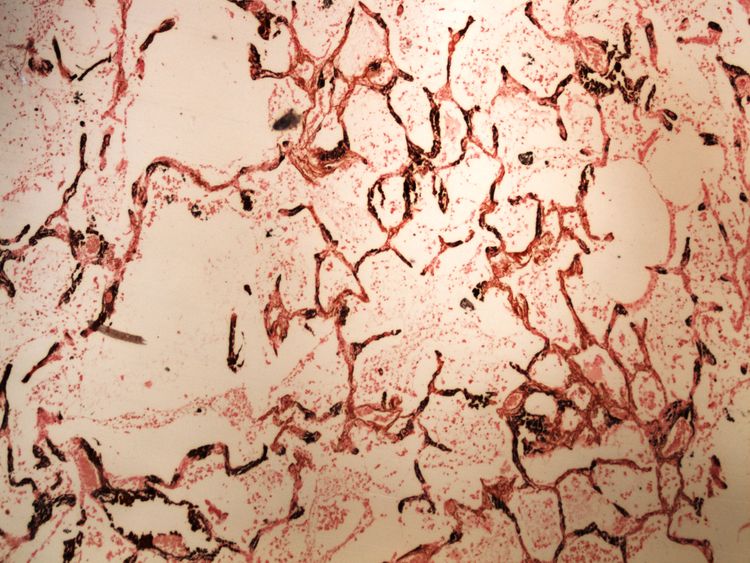 Metastatic calcification metastaticka kalcifikace Kossa 4x.jpg