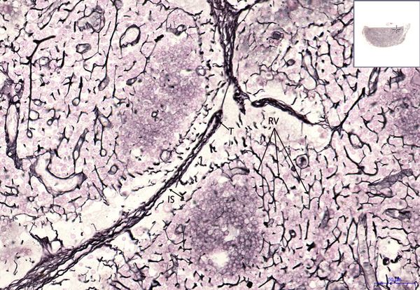 Lymph node AG 20x.jpeg