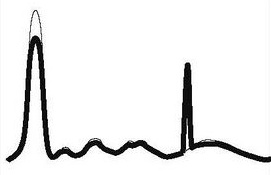 ELFO monoclonal gammopathy.jpg