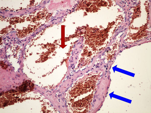 Z 8-10 cavernous haemangioma liver kavernosnii hemangiom jater 20x oznaceno.jpg