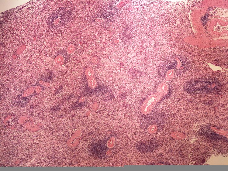 Fibrinoid dystrophy fibrinoidni dystrofie arteriol 4x.jpg