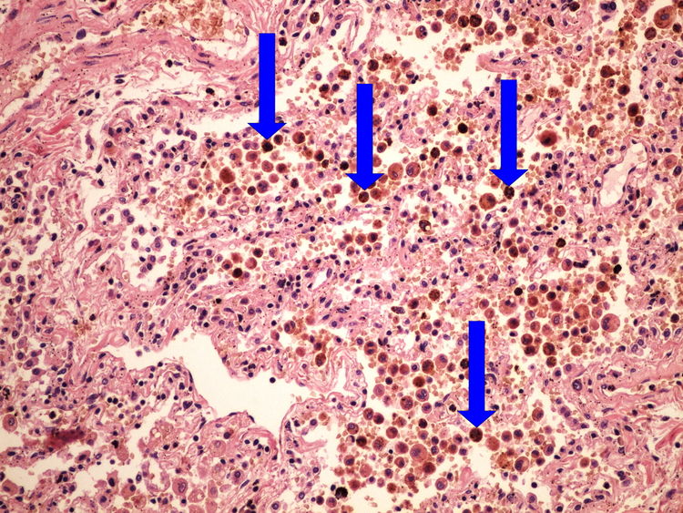 Z4-2 hemosiderin 20x oznaceno.jpg