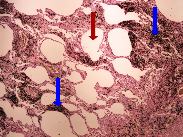 Z4-4 anthracosis antrakoza 4x oznaceno.jpg