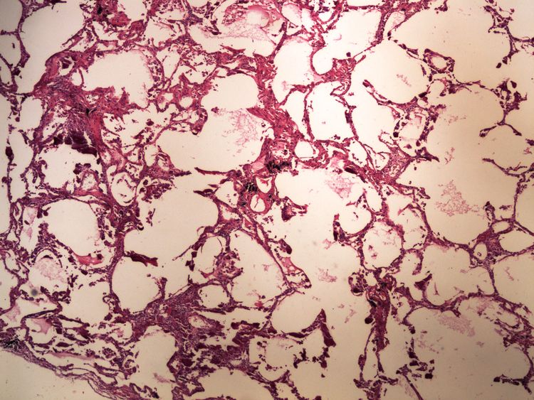 Metastatic calcification metastaticka kalcifikace HE 4x.jpg
