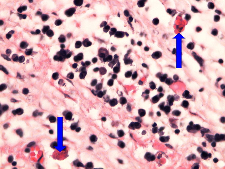 Z3-3 Russel bodies Russelova teliska 60x oznaceno.jpg