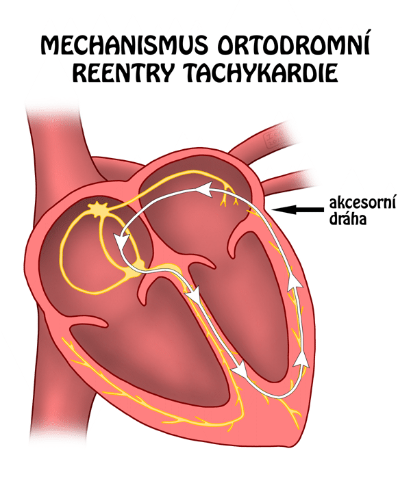 Reentry Heart Reentry - WikiLectures