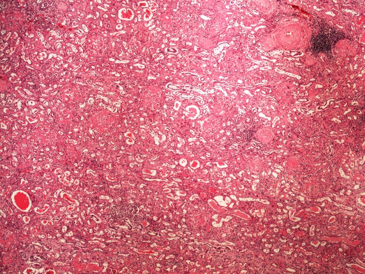 Amyloidosis kidney amyloidoza ledviny HE 4x.jpg