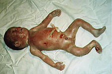 Clinical picture of microcephaly, hypertelorism, "carp mouth", cleft lip, postpartum hypotonia, defects of the heart, kidneys, skeletal system, hypospadias Cause of chromosomal aberration on the 4th chromosome Prenatal diagnostics, genetic testing Investigation in the Czech Republic CG21 Worldwide incidence 1:50,000 Prognosis by phenotype; 20-40 years