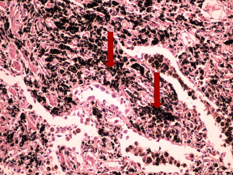 Z4-4 anthracosis antrakoza20x oznaceno.jpg