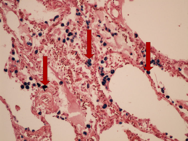 Z1-9 Pearls reaction (lung) prukaz zeleza (plice) 20x oznaceno.jpg