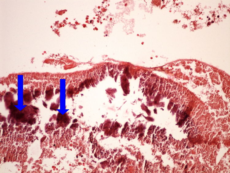 Z4-8 dystrophic calcification dystroficka kalcifikace 20x oznaceno.jpg