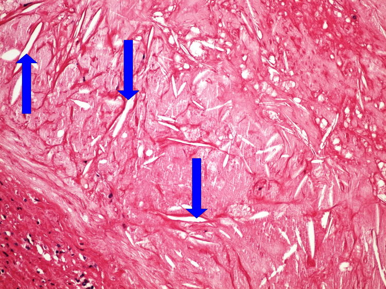 Z4-6 cholesterol clefts cholesterolove krystaly 20x oznaceno.jpg