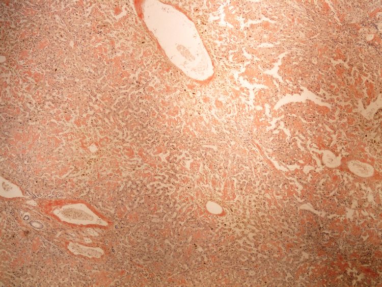 Amyloidosis liver amyloidoza jater kongo 4x.jpg