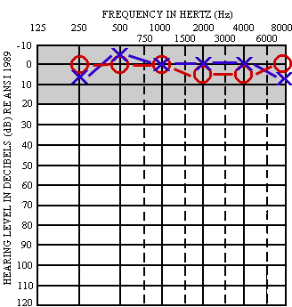Audiogram for a Patient With Normal Hearing.gif