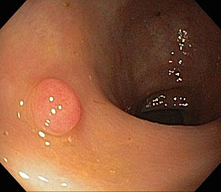 Sessile serous adenoma - endoscopy