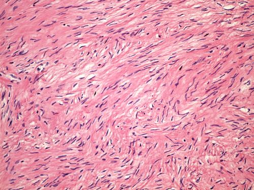 Uterine leiomyoma leiomyom delohy 20x.jpg