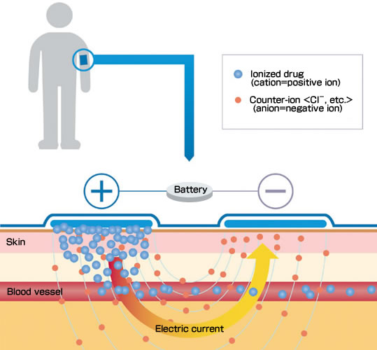 Iontophoresis WikiLectures