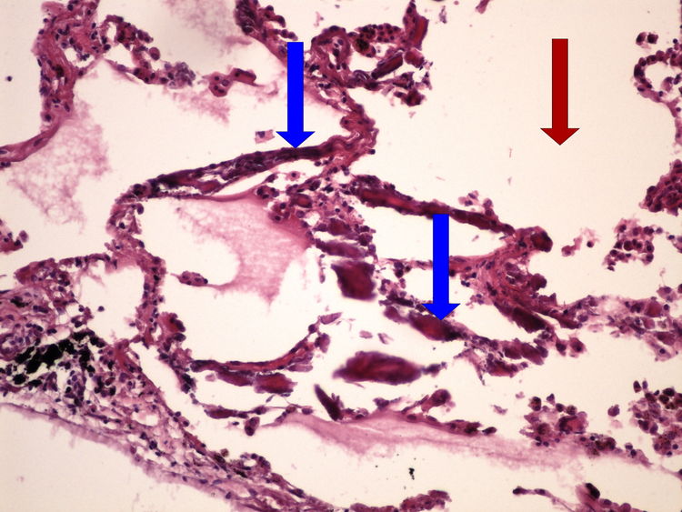 Z4-9A metastatic calcification metastaticka kalcifikace HE 20x oznaceno.jpg
