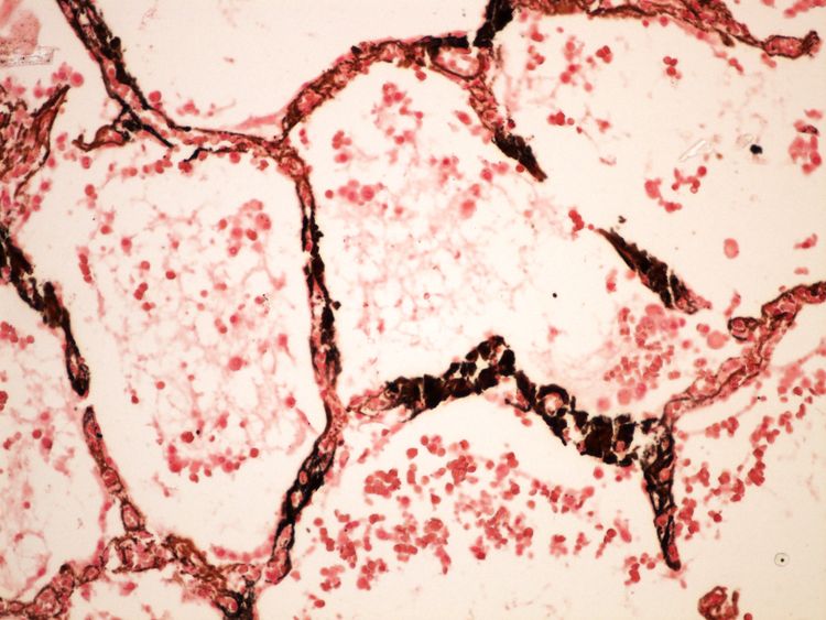 Metastatic calcification metastaticka kalcifikace HE (2) 20x.jpg