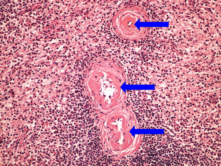 Z3-9 fibrinoid dystrophy fibrinodni dystrofie 20x oznaceno.jpg