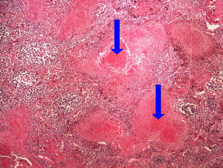 Z4-5 silicosis silikoza 4x oznaceno.jpg