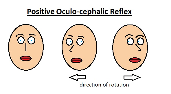 Positive oculo-cephalic reflex