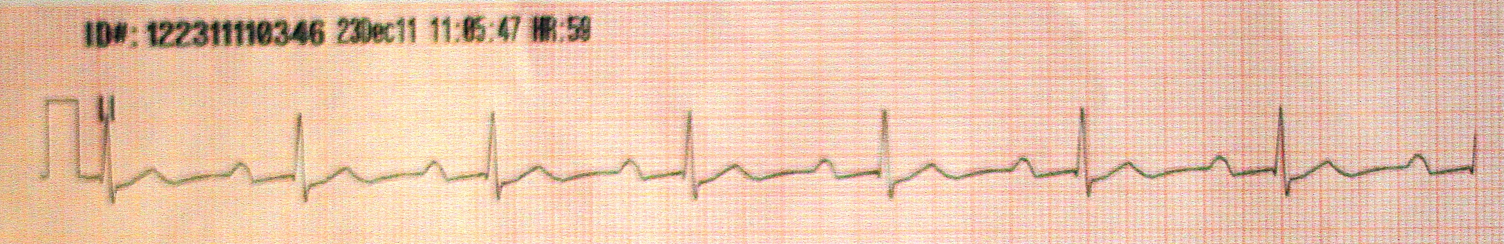 A-V Block I Grade