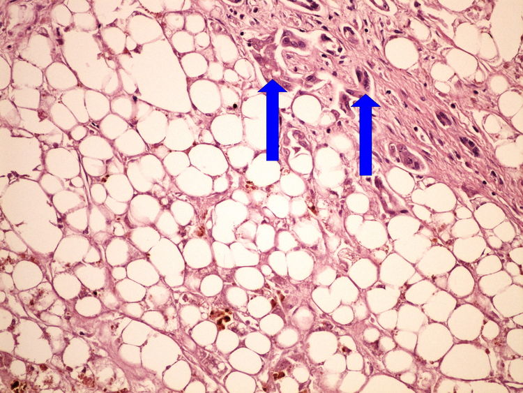 Z3-4 steatosis hepatis steatosa jater 20x oznaceno.jpg