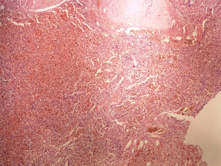 Hemosiderin 4x.jpg