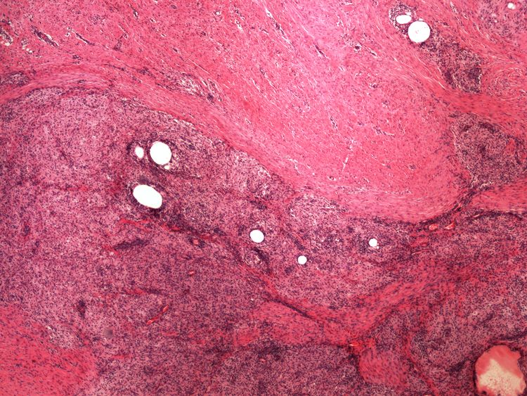 Inflammatory pseudoxanthoma zanetlivy pseudoxantom 4x.jpg