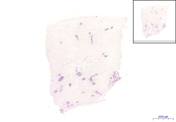 Mamma non lactans, HE 0.6x.jpeg